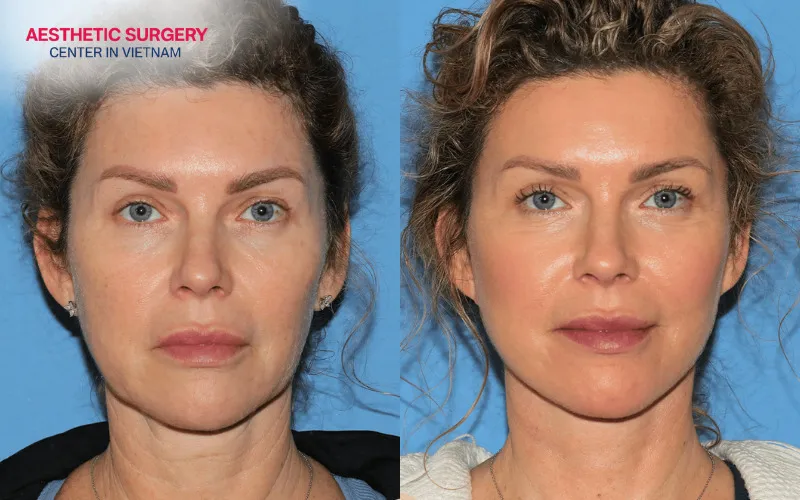 A slimmer, more defined neck contour helps the entire face appear more youthful.