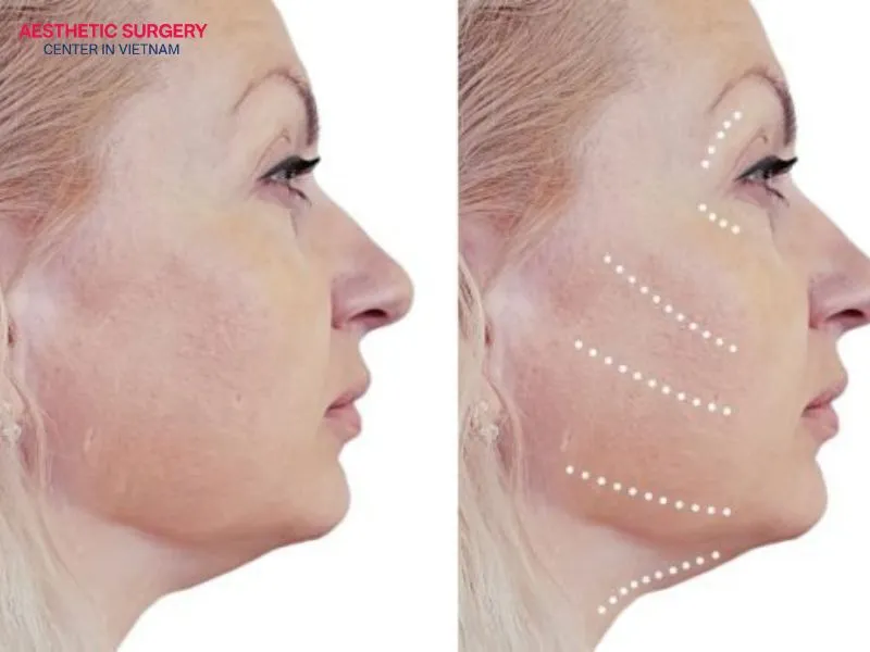 After the first facelift surgery, a waiting period of about 6 to 12 months is generally recommended.