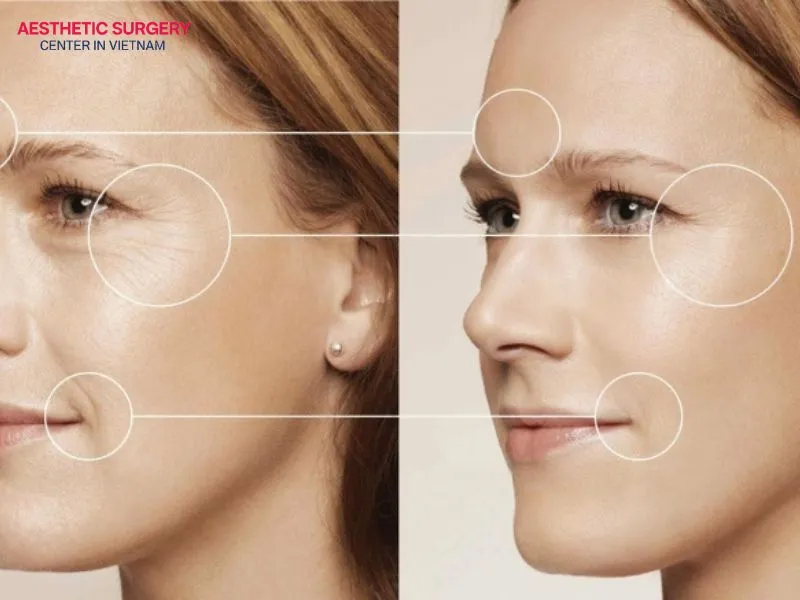 The cost of a facelift revision is not fixed and depends on many different factors.