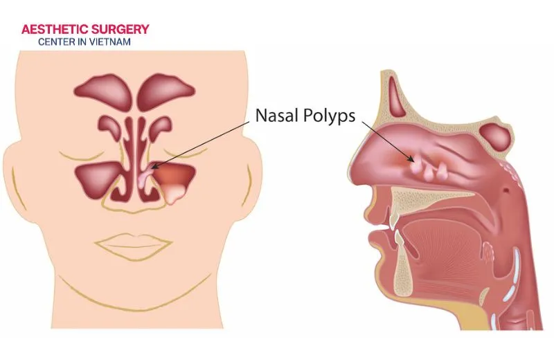 Large or multiple nasal polyps can obstruct the nasal passages, leading to breathing difficulties and persistent sinus infections.