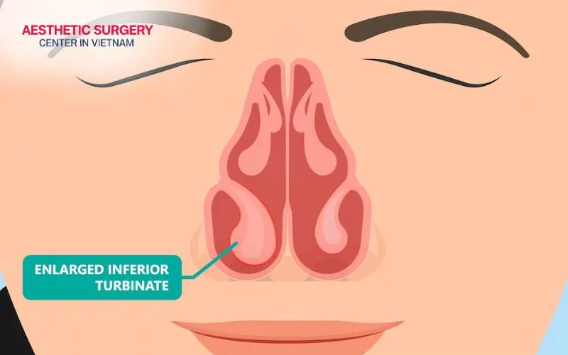 Enlarged turbinates can narrow the nasal passages, making it difficult to breathe comfortably through the nose.