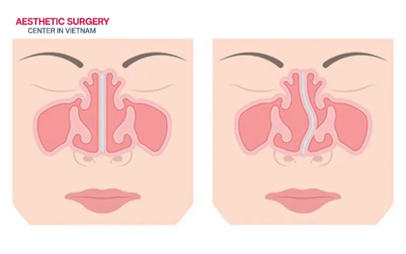 Below is a step-by-step overview of what you can expect during the procedure: