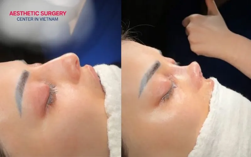 Rhinoplasty can lead to complications such as deviation, nasal tip contracture, or nasal compression.