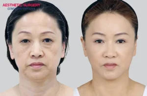 Detailed facelift surgery techniques
