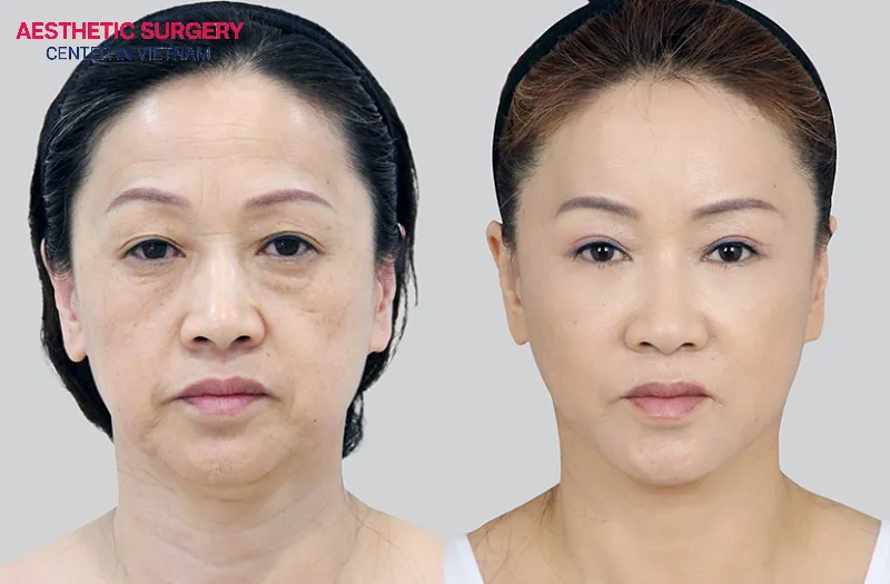 Each facelift technique has its own characteristics and approach, but all of them aim to rejuvenate the facial appearance.