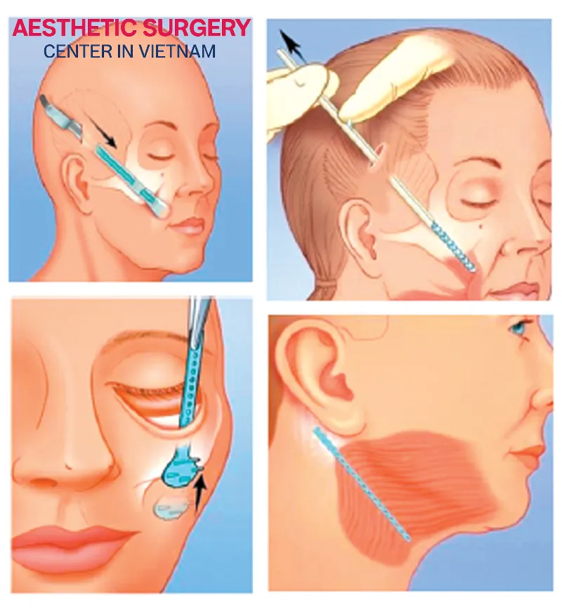 Each incision technique is suitable for different facelift procedures and treatment goals.