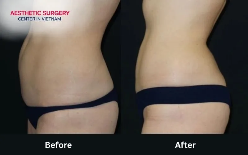 Aesthetic results before and after coolsculpting treatment.
