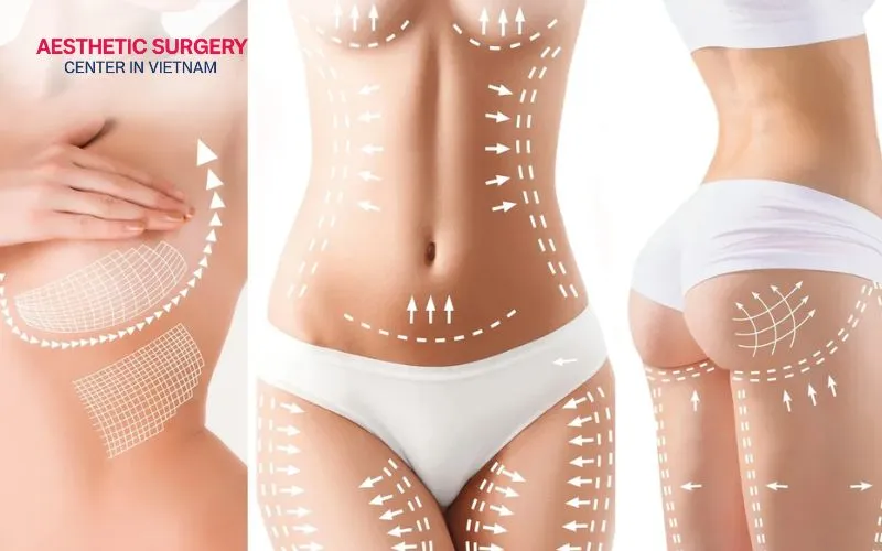 Liposuction provides immediate reduction of excess fat volume by directly removing fat deposits in a single procedure.