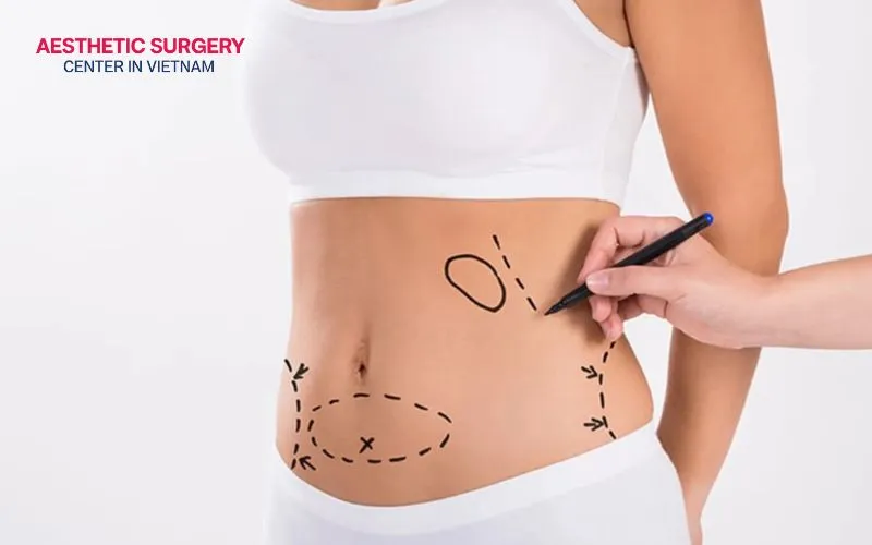If you want to reduce body measurements and achieve a slimmer, more contoured figure quickly, liposuction may be the right choice for you.