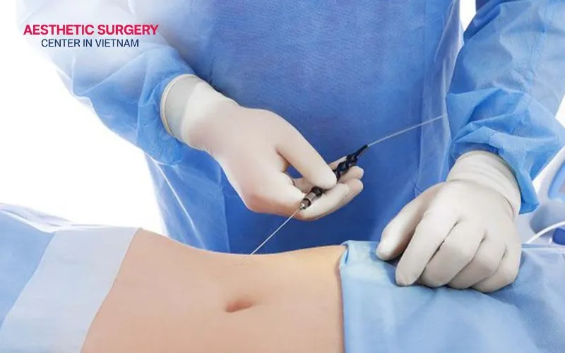 The liposuction procedure uses a cannula connected to a vacuum suction device to remove fat from the body.