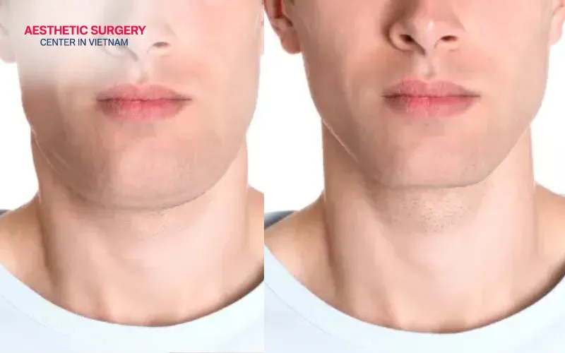 The neck structure appears more defined and sculpted after surgery.