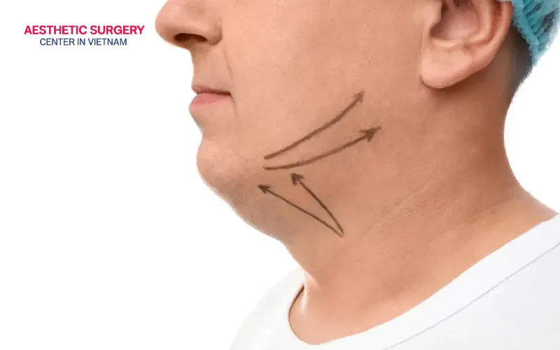A male neck lift utilizes advanced deep-plane techniques to reposition and reshape the underlying muscle structures.