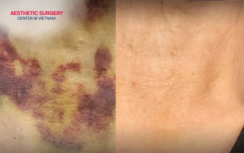 After the third month, the surgical area gradually stabilizes and settles into its final contour.