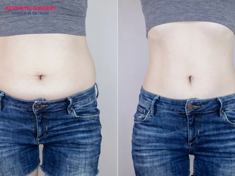 Micro liposuction offers a range of outstanding benefits for patients seeking body contouring and fat reduction.