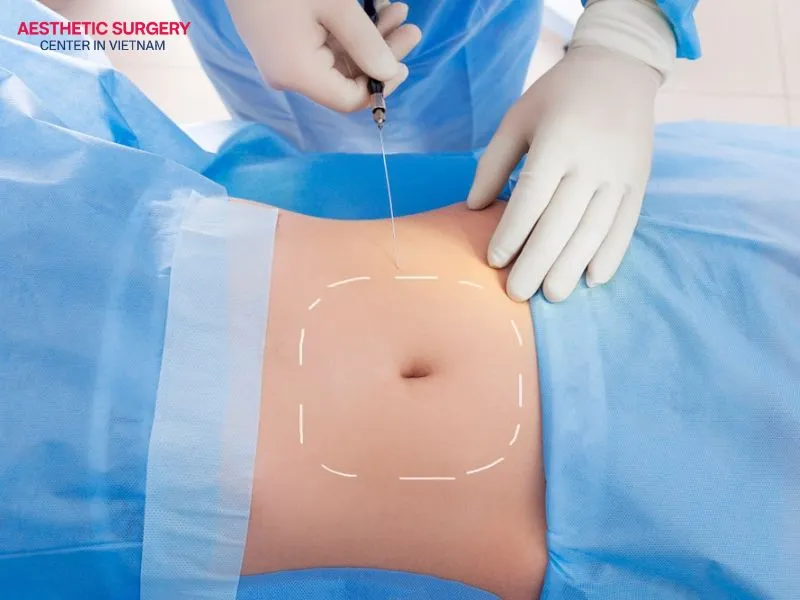 Micro liposuction is performed through a four-step medically standardized procedure.