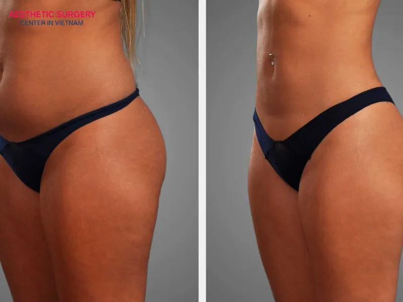 The cost of liposuction micro typically ranges from VND 15 million to VND 90 million, depending on several factors.