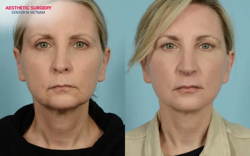 Noticeable facial rejuvenation can be seen in the before and after results of a mini neck lift.