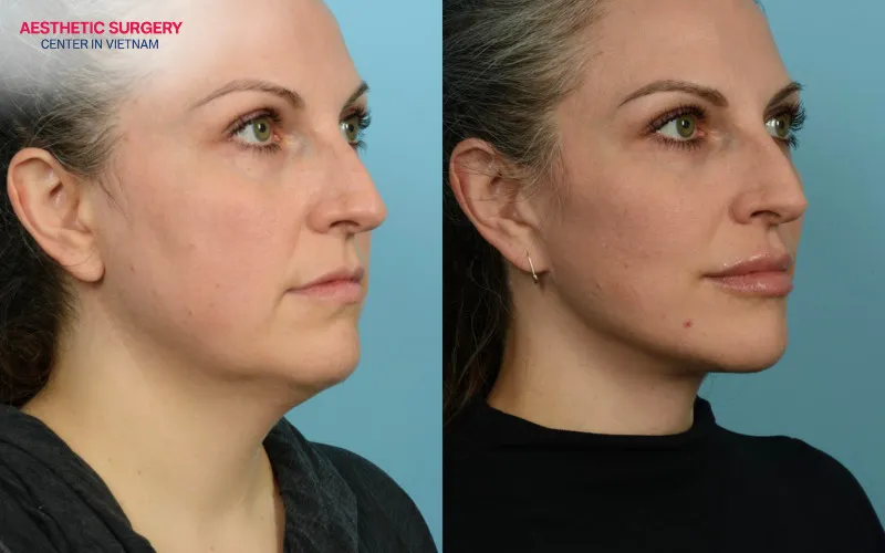 A more youthful appearance is achieved by addressing a double chin and tightening the neck muscles.