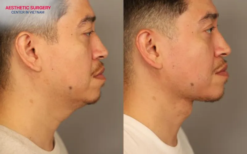 Whether for men or women, the procedure can deliver the rejuvenating results patients desire.