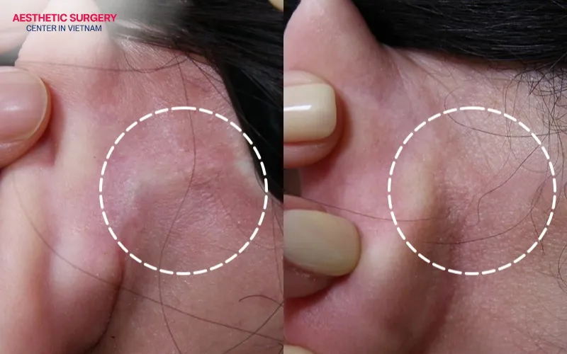 Once healed, the incision blends naturally with the surrounding skin tone and is barely noticeable.