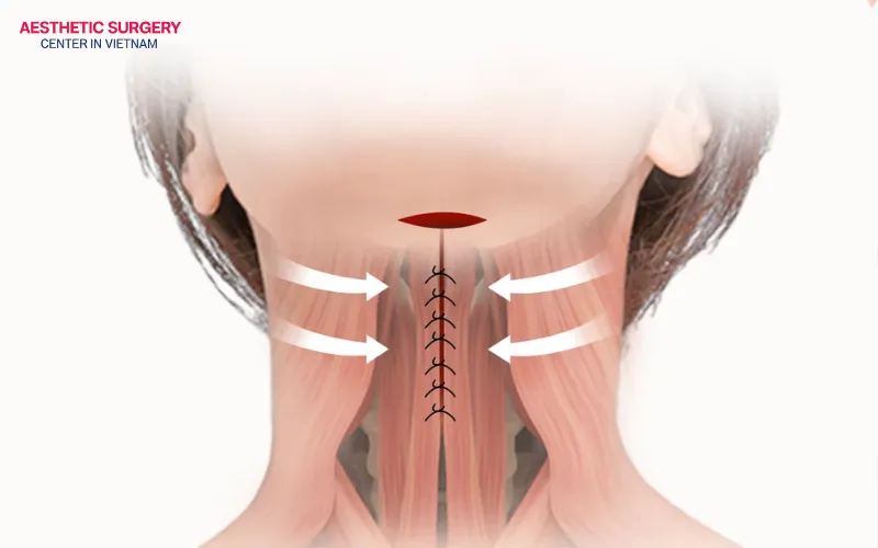 The procedure is performed through a small, discreet incision carefully placed beneath the chin.