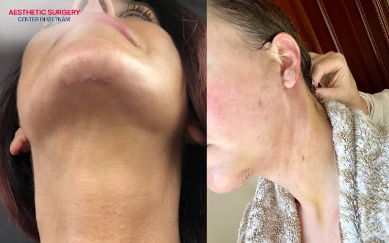 The treated area is typically fully stabilized and well-defined within approximately three weeks.