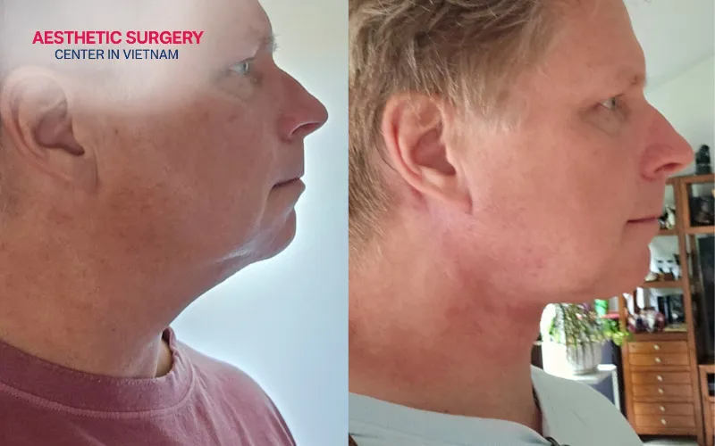 The neck contour becomes more defined and slimmer.