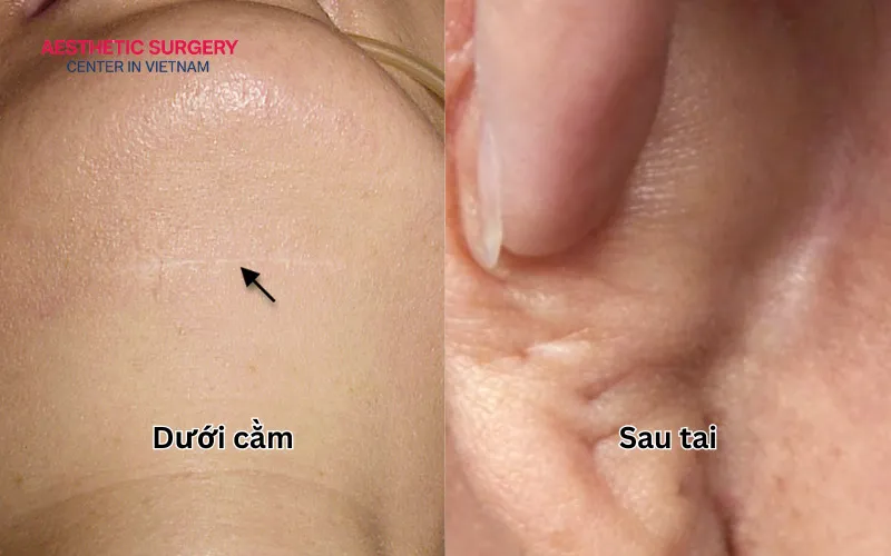 Neck lift scars are usually placed under the chin or behind the ears, making them very difficult to notice.