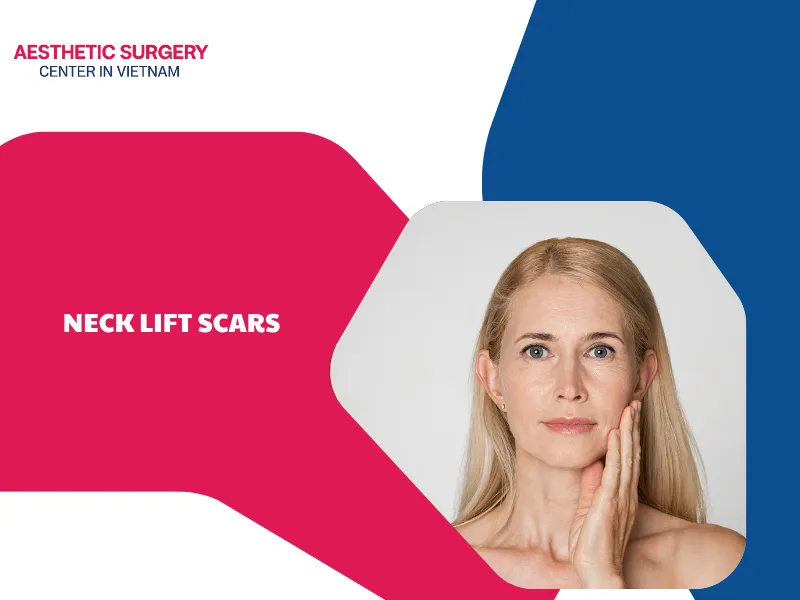 Where are neck lift scars located? Effective prevention methods
