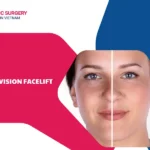 Is facelift revision safe? Important things you need to know