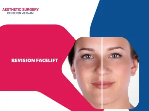 Is facelift revision safe? Important things you need to know