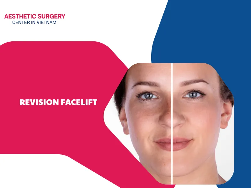 Is facelift revision safe? Important things you need to know