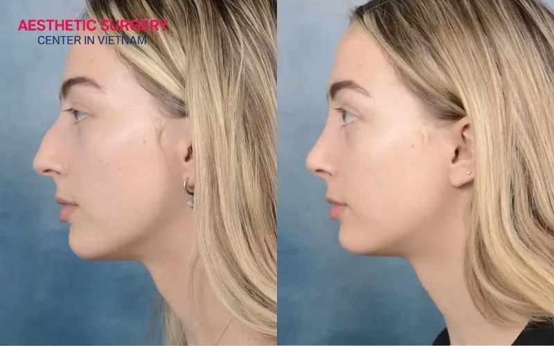 The new nose shape settles into a natural form 1 year after the surgery date.