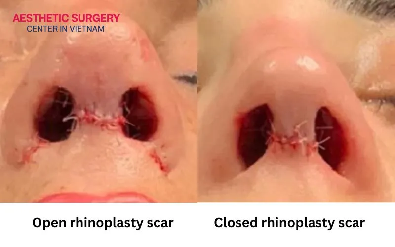 Position and appearance of rhinoplasty scars