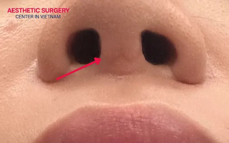 Rhinoplasty scars will gradually fade over time if the prescribed aftercare protocol is followed.