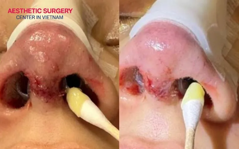 Proper at-home wound care to prevent infection and necrosis