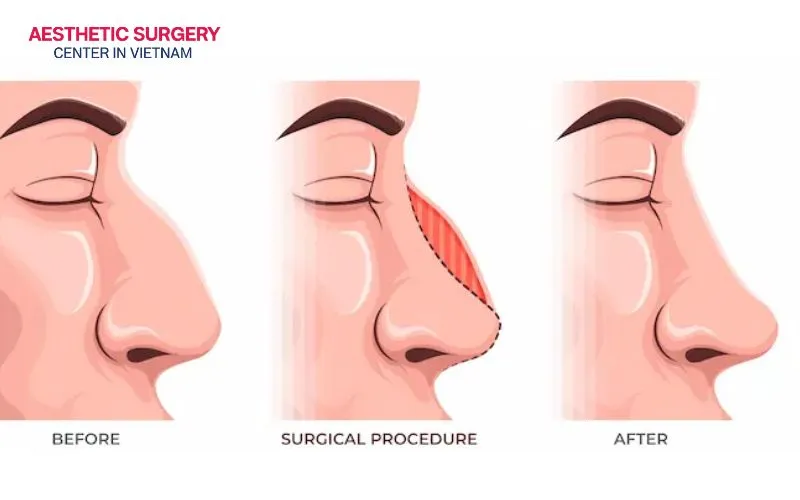 Rhinoplasty helps improve and reshape a nose affected by structural or aesthetic imperfections.