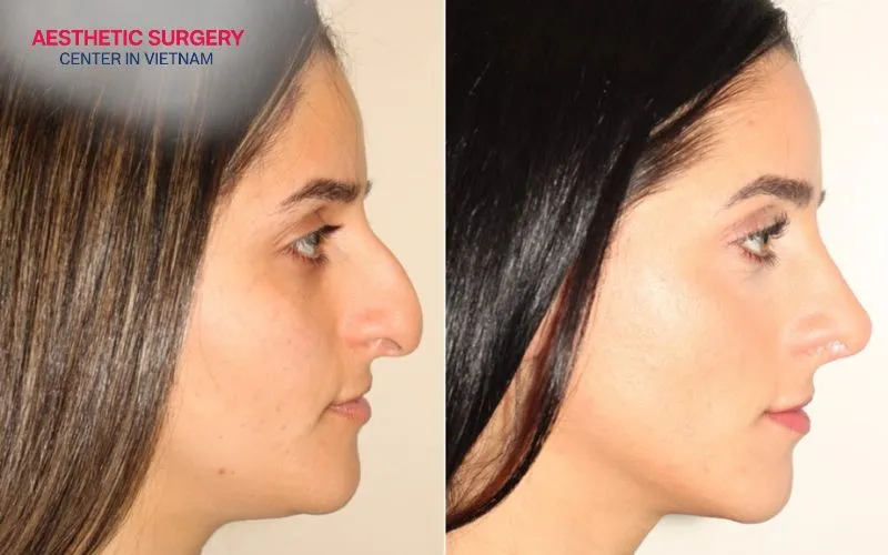 The primary benefit of rhinoplasty is transforming and enhancing the overall appearance of the nose and facial profile.