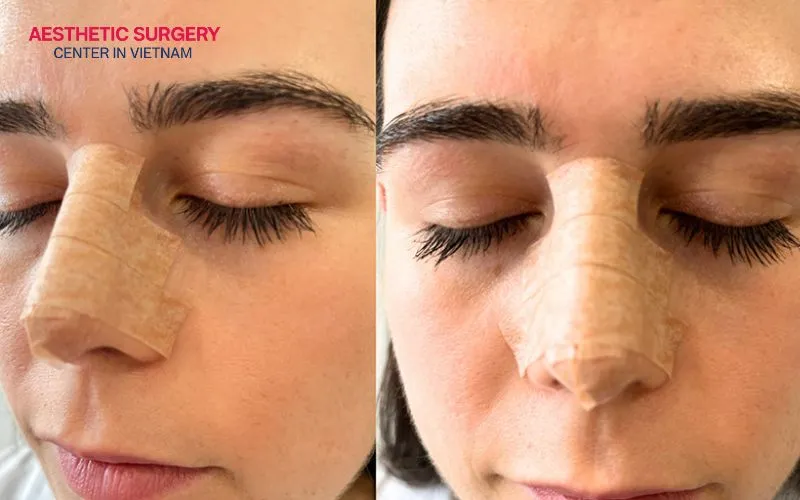 Rhinoplasty may require up to 12 months for the nose to fully settle into its final shape.