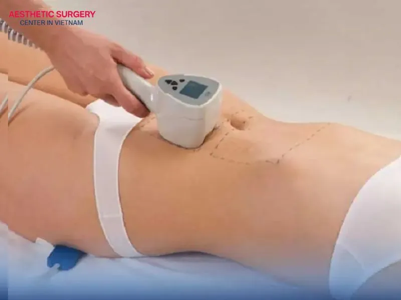 The cost of ultrasonic liposuction in Vietnam typically ranges from VND 15 million to VND 150 million, depending on various factors.