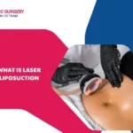 What is laser liposuction? Procedure, costs and benefits