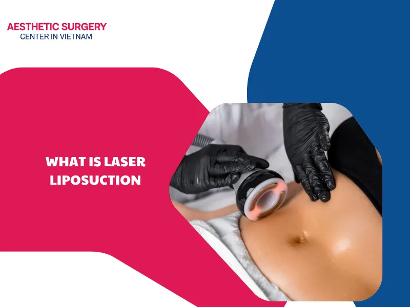 What is laser liposuction? Procedure, costs and benefits