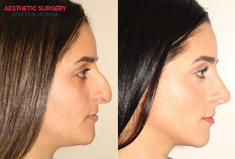 A finesse nose job is a procedure that corrects minor nasal imperfections, such as refining the nasal tip, adjusting the nostrils, or smoothing a small dorsal hump.