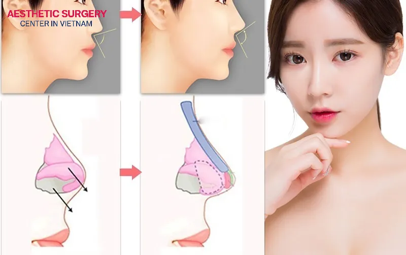 Finesse rhinoplasty is painless during the procedure, although you may experience mild tightness afterward.