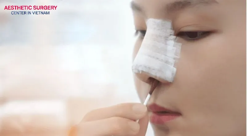 The recovery process after rhinoplasty typically takes about 6 months to complete.