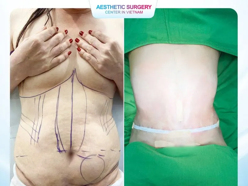 Aesthetics Surgery Center is a trusted and safe destination for full body liposuction, chosen by numerous clients in Ho Chi Minh City.