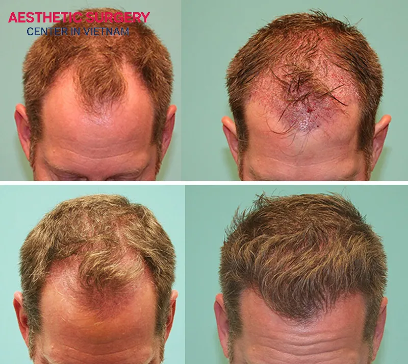 Patients with extensive baldness are ideal candidates for a FUT hair transplant.
