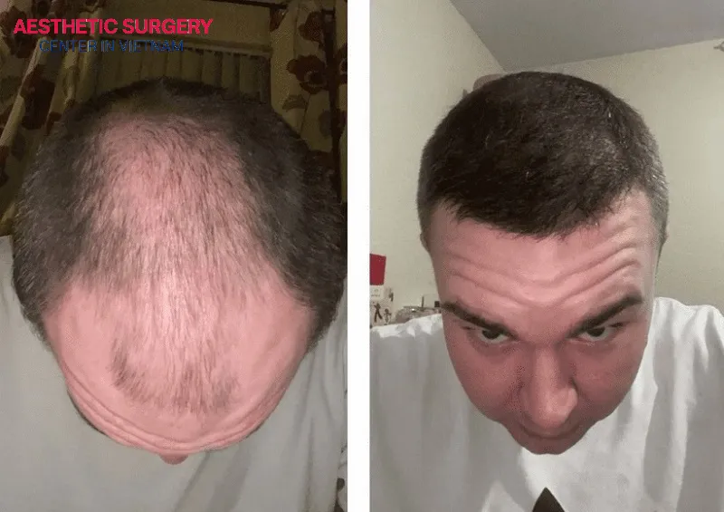 A FUT hair transplant provides a high hair graft survival rate.