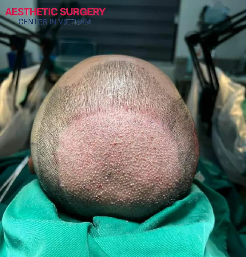 After a hair transplant, both the donor area and the recipient area should be cared for carefully.