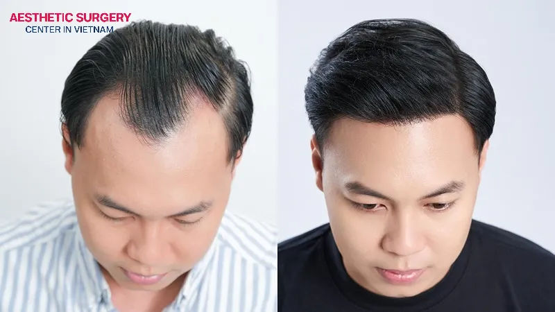 The transplanted hair will grow steadily and achieve natural-looking results within 4–12 months.